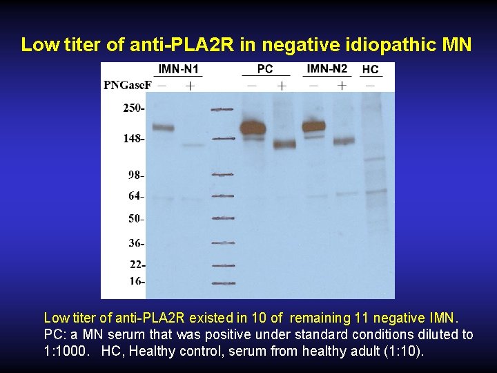 Low titer of anti-PLA 2 R in negative idiopathic MN Low titer of anti-PLA