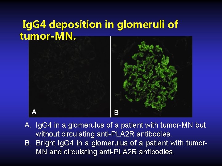 Ig. G 4 deposition in glomeruli of tumor-MN. A. Ig. G 4 in a