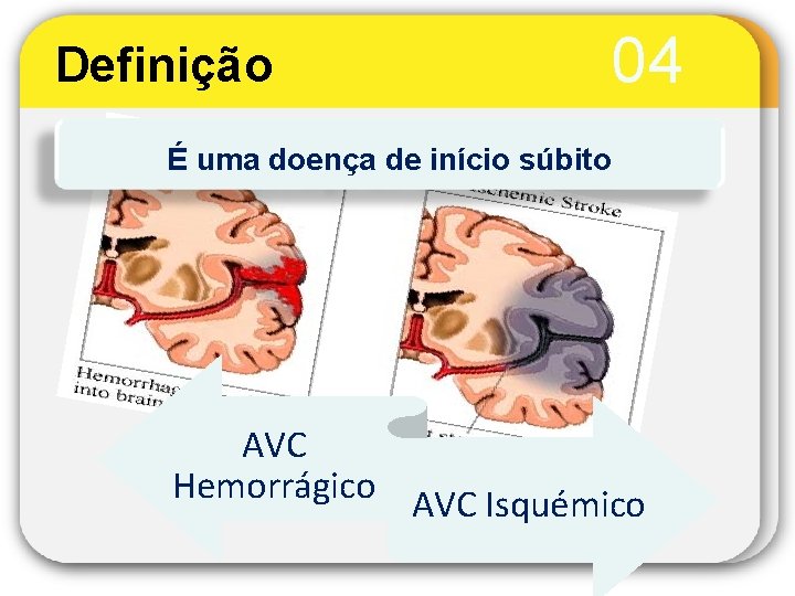 Definição 04 É uma doença de início súbito AVC Hemorrágico AVC Isquémico 