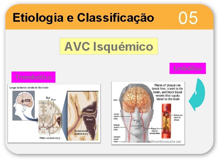 Etiologia e Classificação 05 AVC Isquémico Trombótico Embólico 