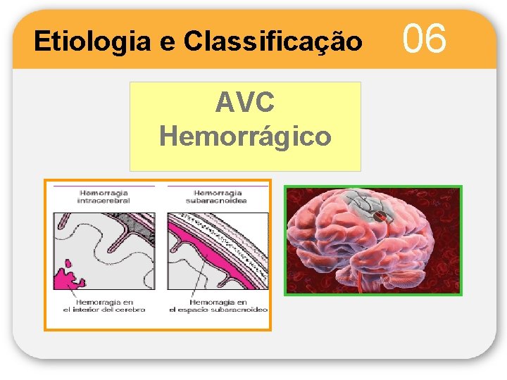 Etiologia e Classificação AVC Hemorrágico 06 
