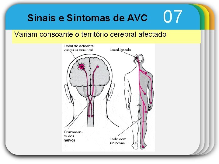 Sinais e Sintomas de AVC 07 Variam consoante o território cerebral afectado 