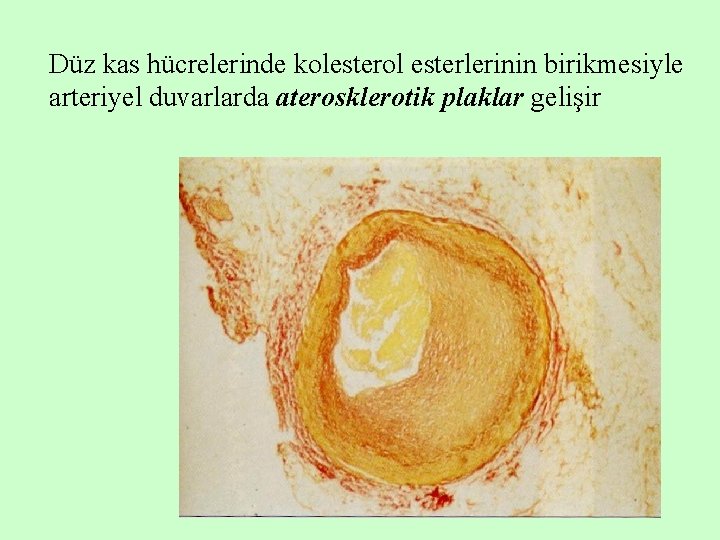Düz kas hücrelerinde kolesterol esterlerinin birikmesiyle arteriyel duvarlarda aterosklerotik plaklar gelişir 