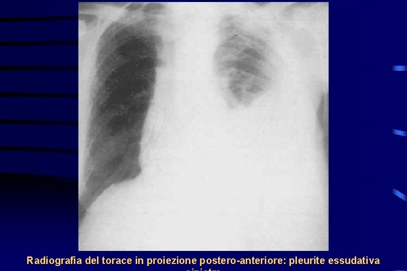 Radiografia del torace in proiezione postero-anteriore: pleurite essudativa 