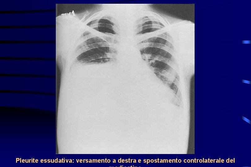 Pleurite essudativa: versamento a destra e spostamento controlaterale del 