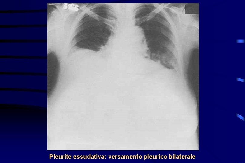 Pleurite essudativa: versamento pleurico bilaterale 