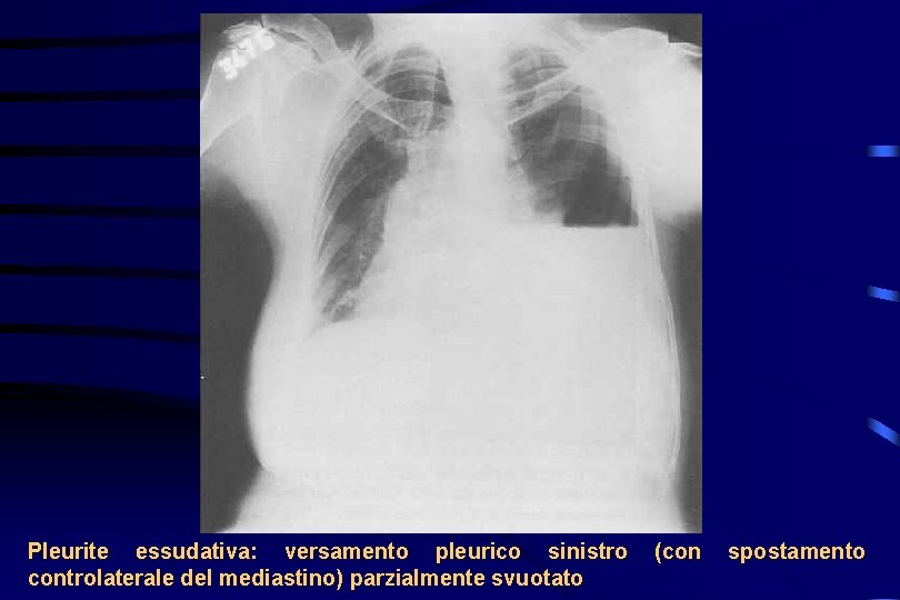 Pleurite essudativa: versamento pleurico sinistro controlaterale del mediastino) parzialmente svuotato (con spostamento 