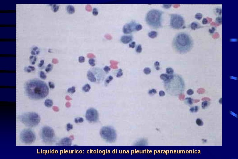 Liquido pleurico: citologia di una pleurite parapneumonica 
