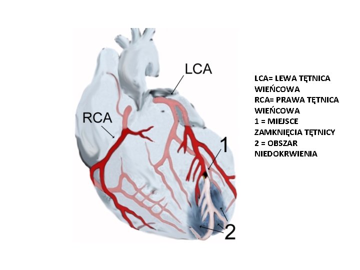 LCA= LEWA TĘTNICA WIEŃCOWA RCA= PRAWA TĘTNICA WIEŃCOWA 1 = MIEJSCE ZAMKNIĘCIA TĘTNICY 2