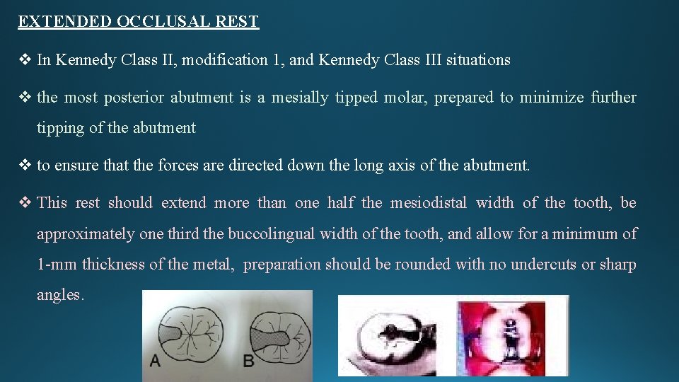 EXTENDED OCCLUSAL REST v In Kennedy Class II, modification 1, and Kennedy Class III
