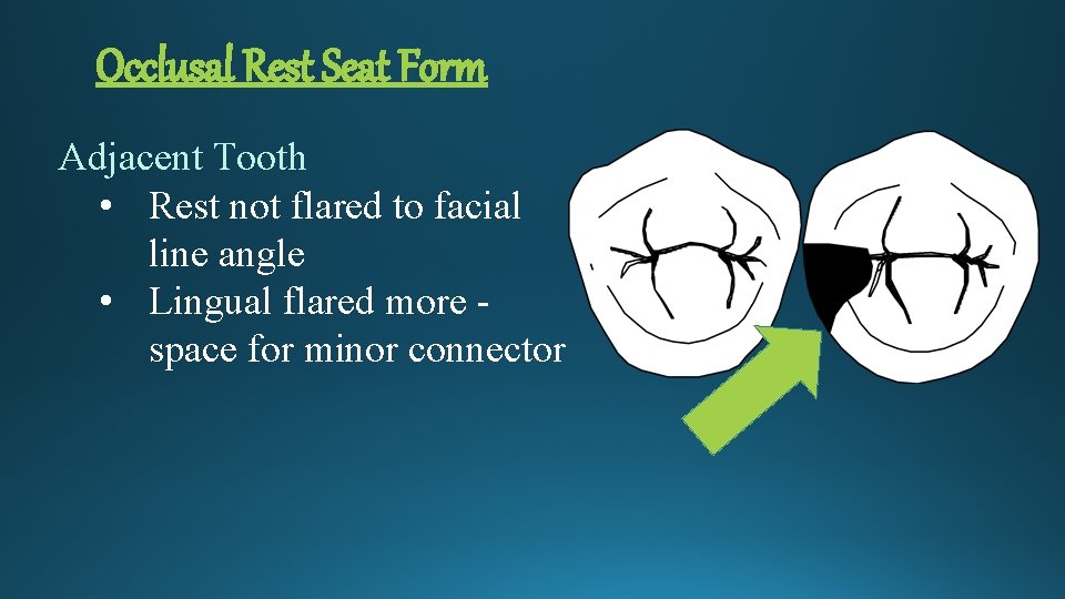 Occlusal Rest Seat Form Adjacent Tooth • Rest not flared to facial line angle