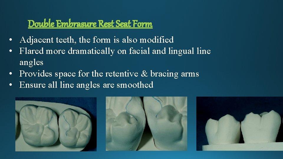 Double Embrasure Rest Seat Form • Adjacent teeth, the form is also modified •