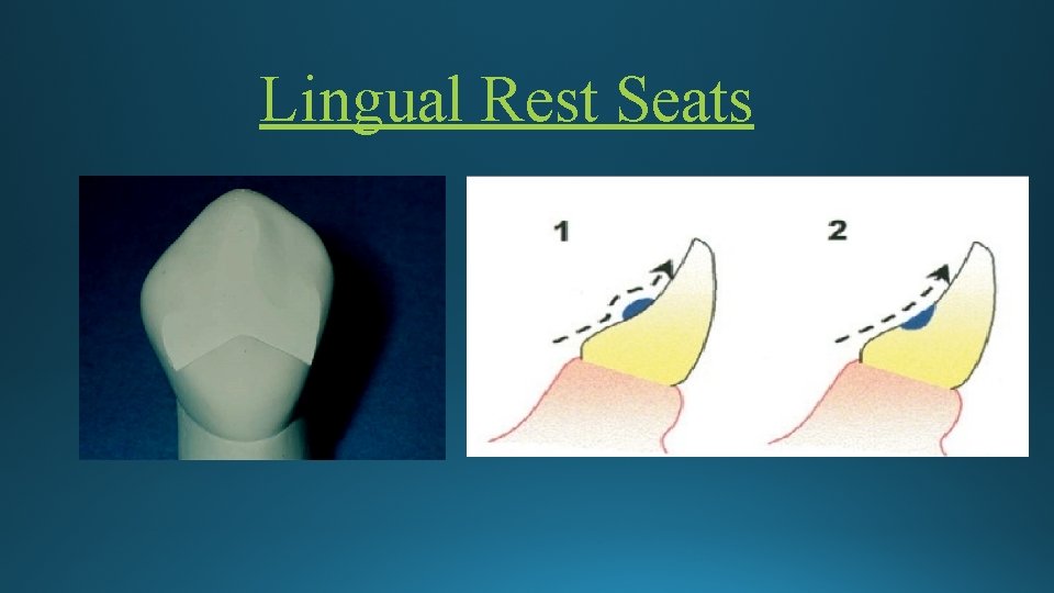 Lingual Rest Seats 