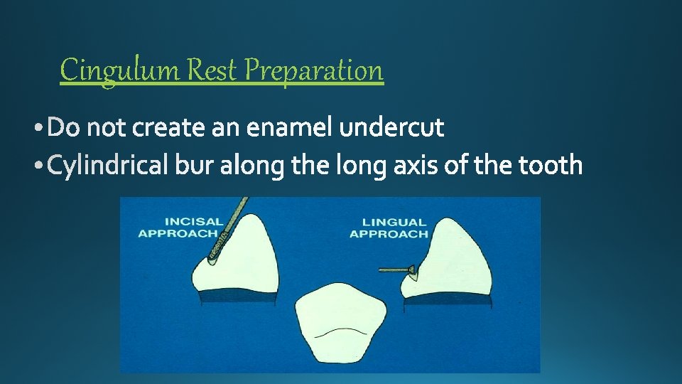 Cingulum Rest Preparation 