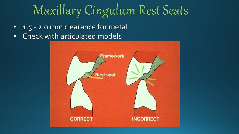 Maxillary Cingulum Rest Seats • 1. 5 - 2. 0 mm clearance for metal