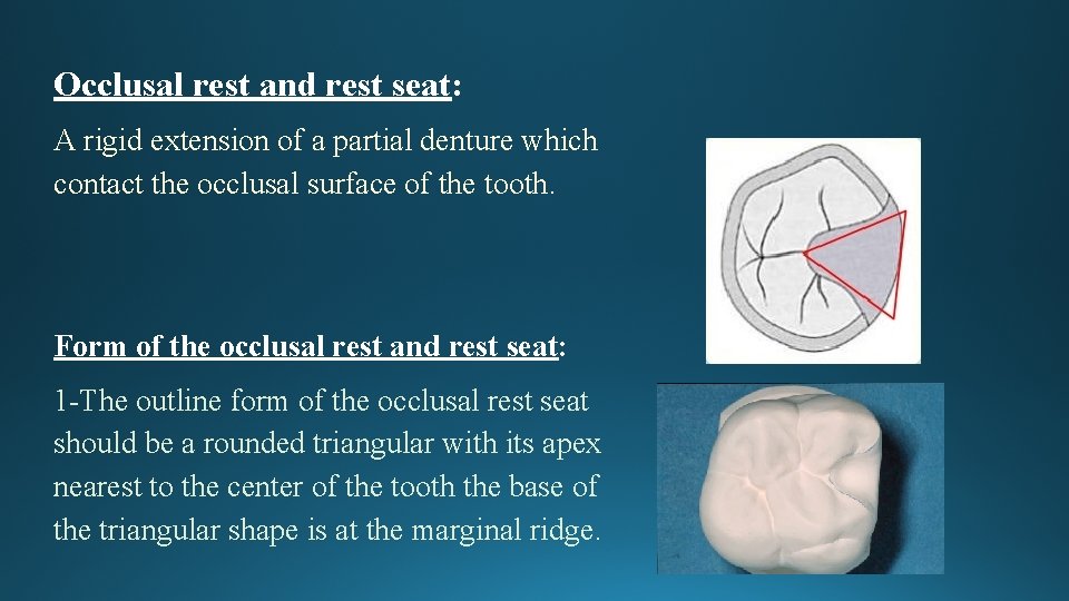 Occlusal rest and rest seat: A rigid extension of a partial denture which contact