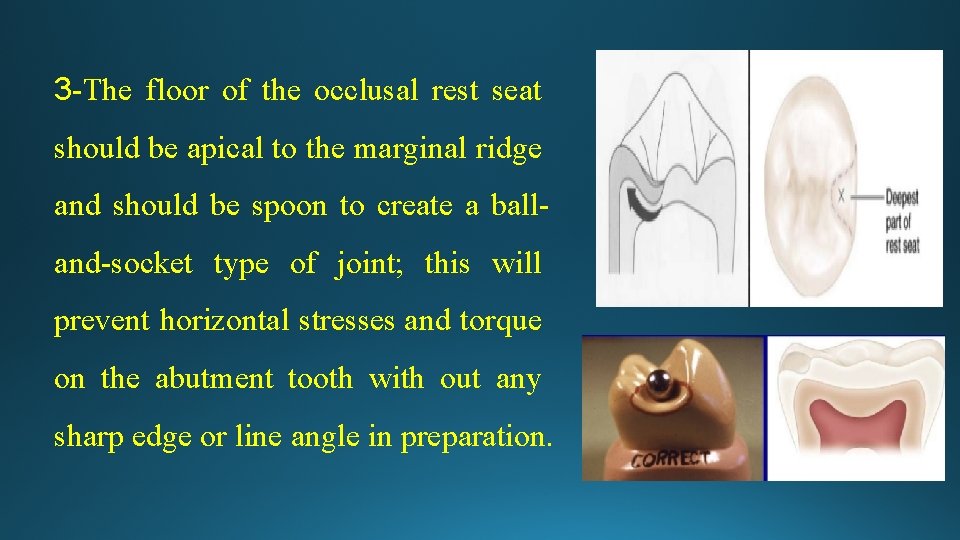 3 -The floor of the occlusal rest seat should be apical to the marginal