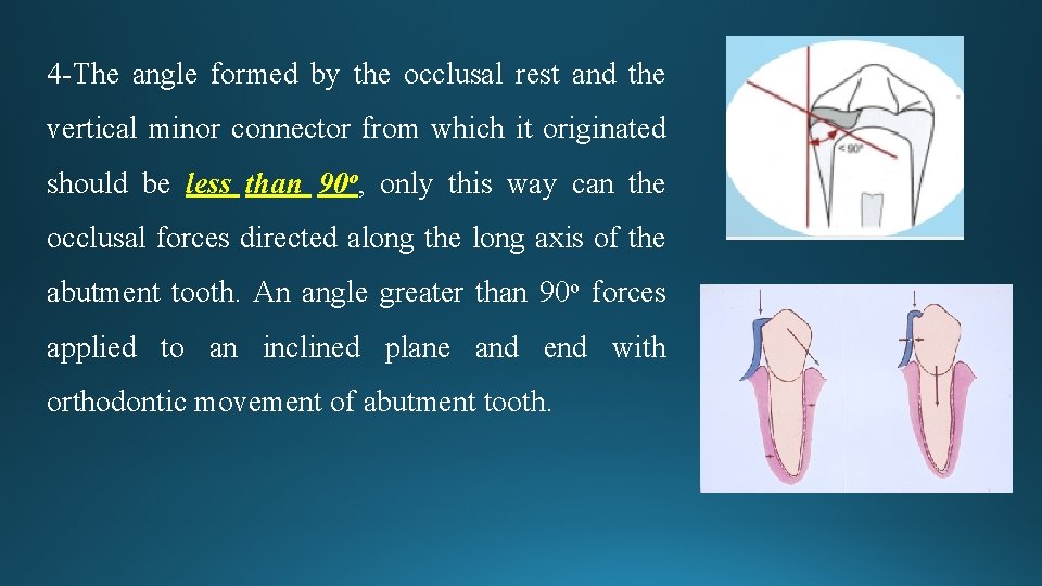 4 -The angle formed by the occlusal rest and the vertical minor connector from