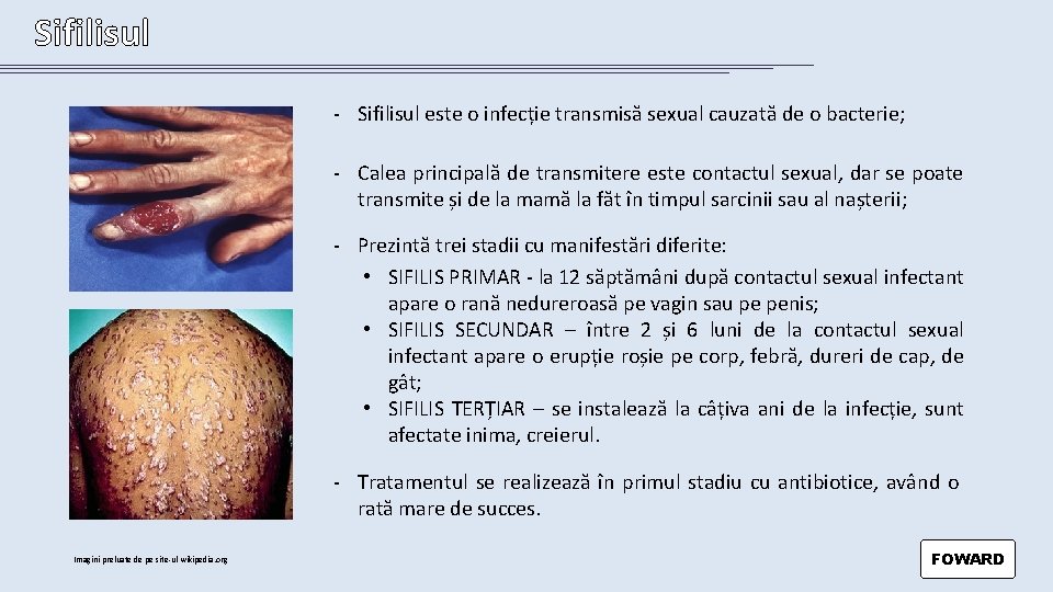 Sifilisul - Sifilisul este o infecție transmisă sexual cauzată de o bacterie; - Calea
