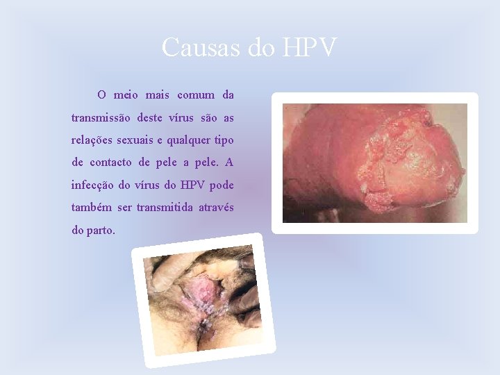 Causas do HPV O meio mais comum da transmissão deste vírus são as relações