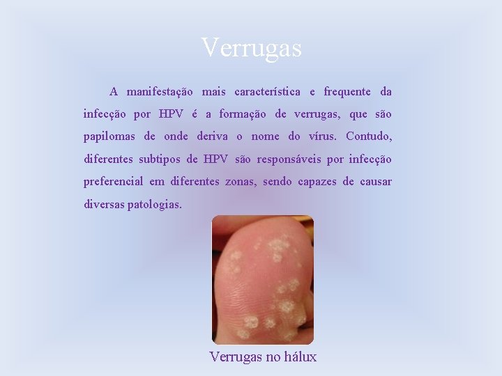 Verrugas A manifestação mais característica e frequente da infecção por HPV é a formação
