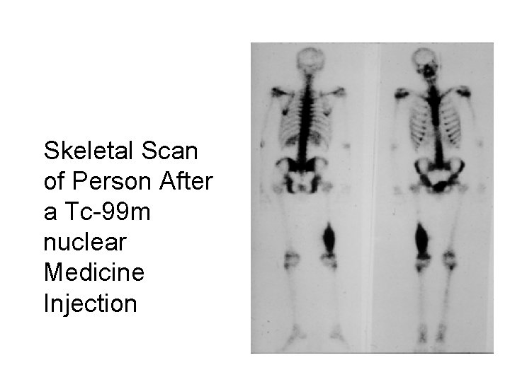 Skeletal Scan of Person After a Tc-99 m nuclear Medicine Injection 