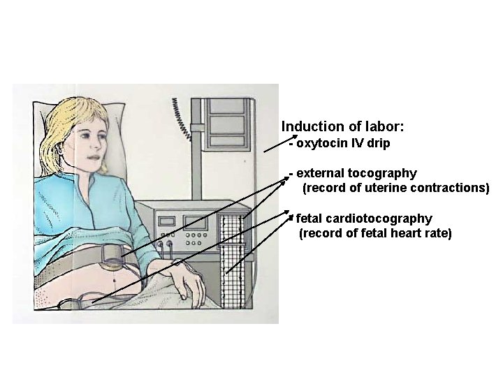 Induction of labor: - oxytocin IV drip - external tocography (record of uterine contractions)