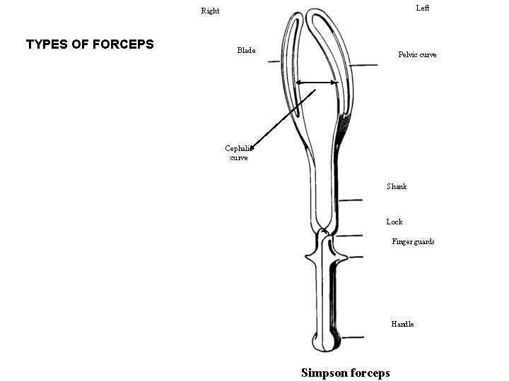 Left Right TYPES OF FORCEPS Blade Pelvic curve Cephalic curve Shank Lock Finger guards