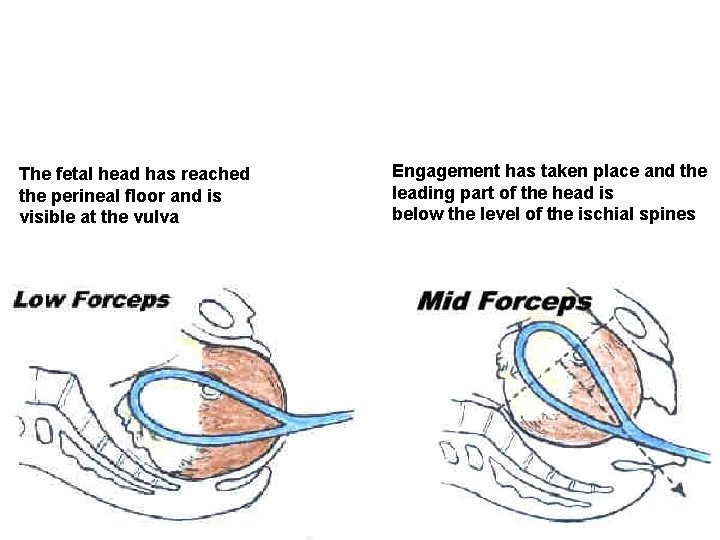 The fetal head has reached the perineal floor and is visible at the vulva