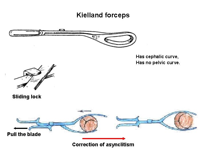 Kielland forceps Has cephalic curve, Has no pelvic curve. Sliding lock Pull the blade
