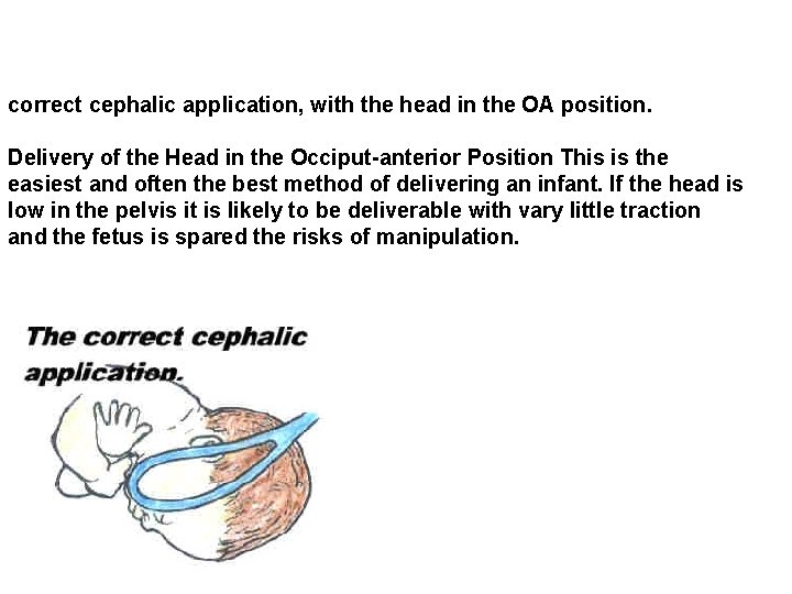 correct cephalic application, with the head in the OA position. Delivery of the Head