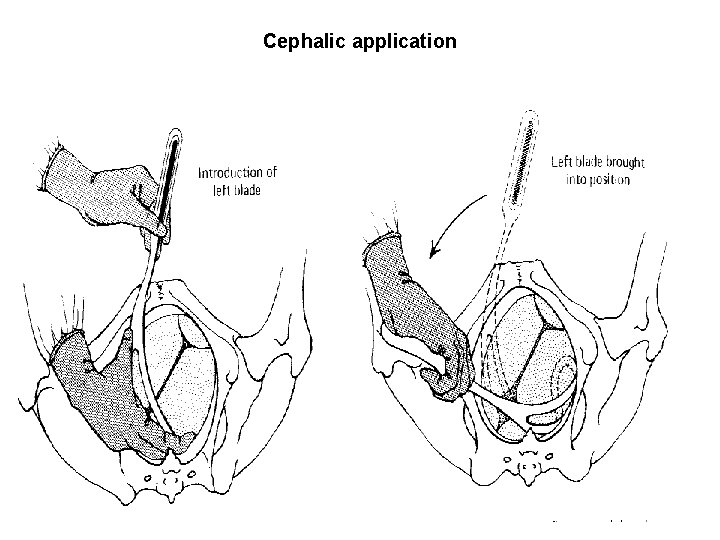 Cephalic application 
