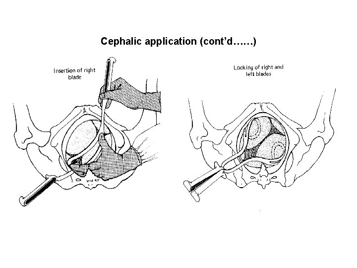 Cephalic application (cont’d……) 