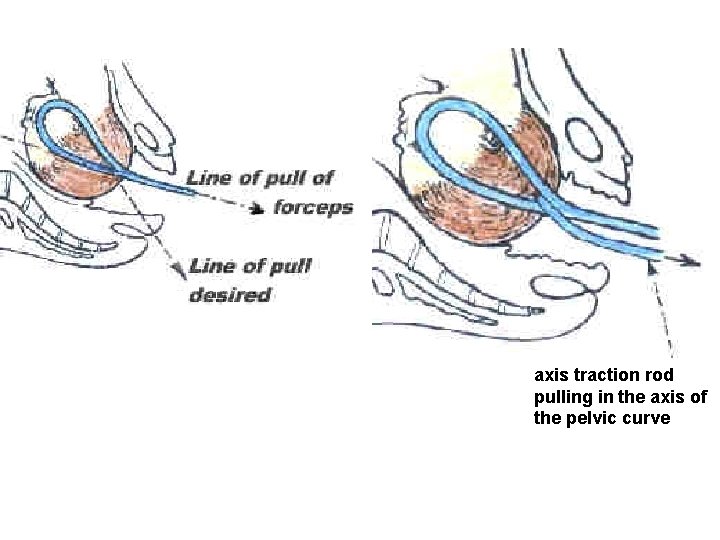 axis traction rod pulling in the axis of the pelvic curve 