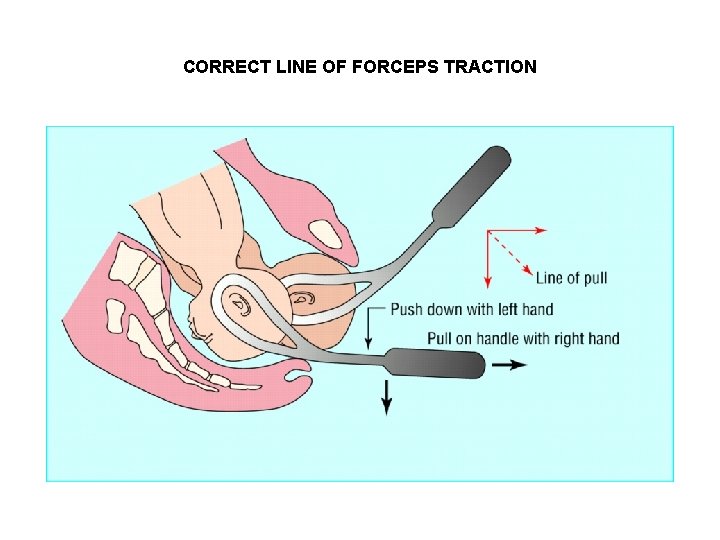 CORRECT LINE OF FORCEPS TRACTION 