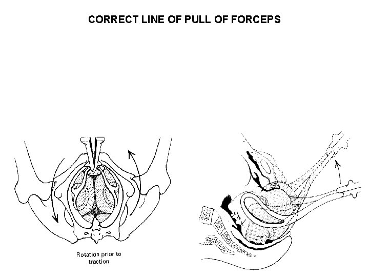 CORRECT LINE OF PULL OF FORCEPS 