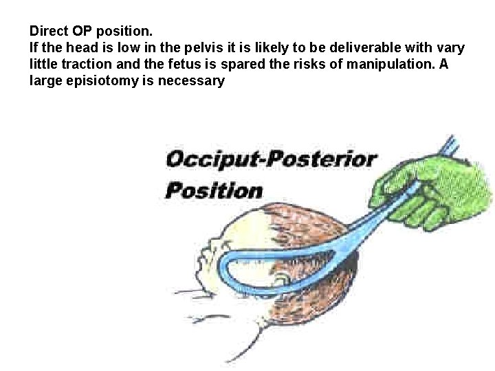 Direct OP position. If the head is low in the pelvis it is likely