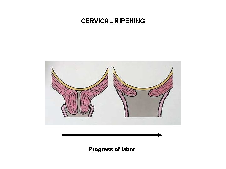 CERVICAL RIPENING Progress of labor 