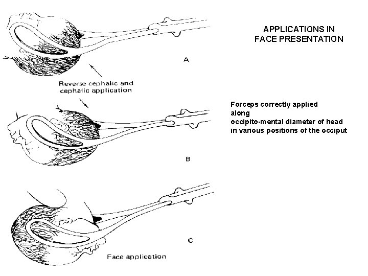 APPLICATIONS IN FACE PRESENTATION Forceps correctly applied along occipito-mental diameter of head in various