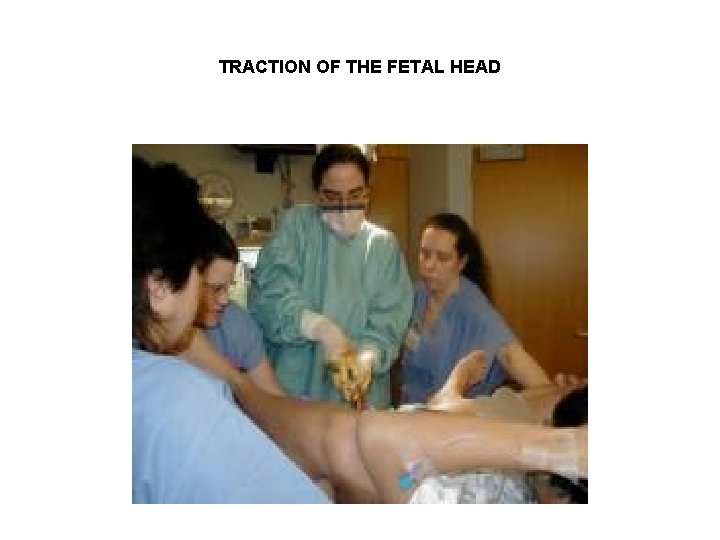 TRACTION OF THE FETAL HEAD 