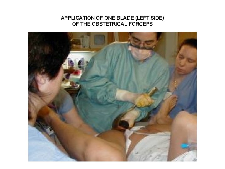 APPLICATION OF ONE BLADE (LEFT SIDE) OF THE OBSTETRICAL FORCEPS 