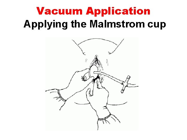 Vacuum Application Applying the Malmstrom cup 
