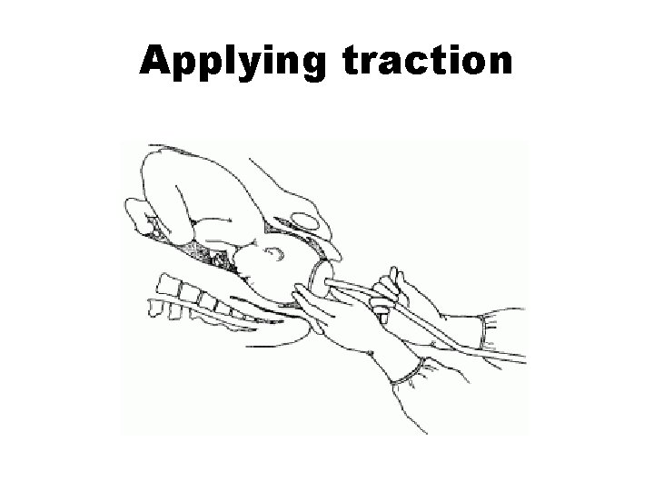 Applying traction 