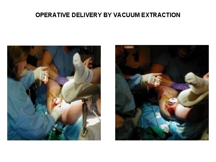 OPERATIVE DELIVERY BY VACUUM EXTRACTION 
