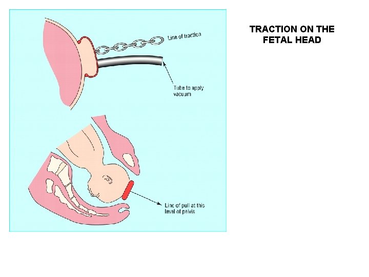 TRACTION ON THE FETAL HEAD 