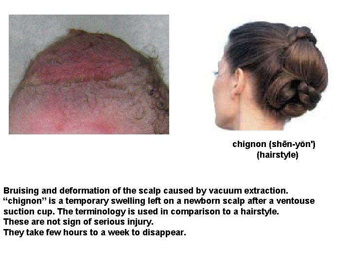 chignon (shēn-yŏn') (hairstyle) Bruising and deformation of the scalp caused by vacuum extraction. “chignon”