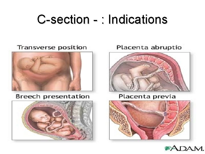 C-section - : Indications 