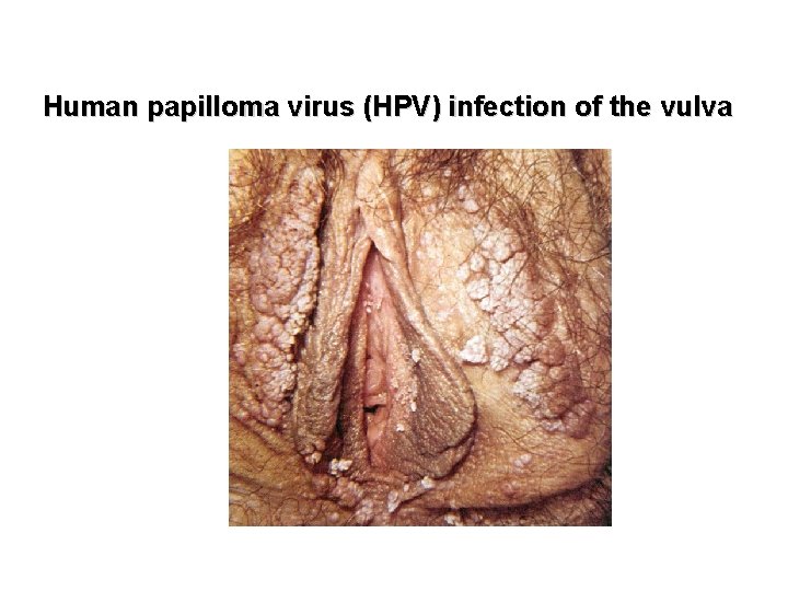 Human papilloma virus (HPV) infection of the vulva 