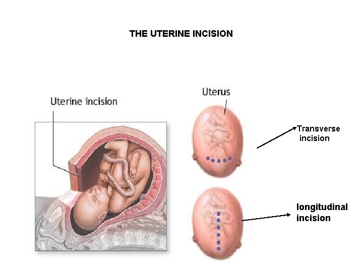 THE UTERINE INCISION Transverse incision longitudinal incision 