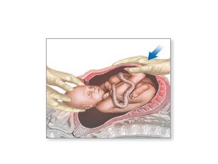 LIFTING THE FETAL HEAD OUT OF THE UTERINE CAVITY. AN ASSISTANT MAY PUSHES DOWN